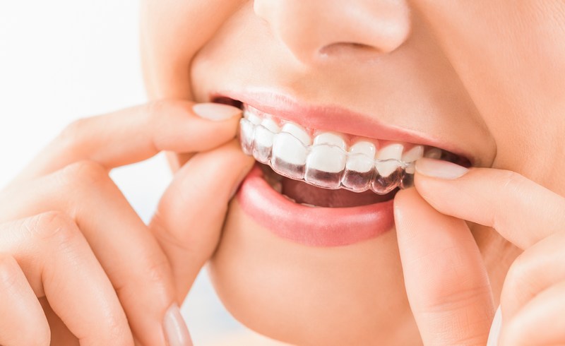 Invisalign-Dentistry-Sumner-WA